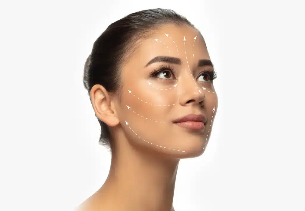 Facial lifting vectors illustrating a face thread lift procedure in Singapore.